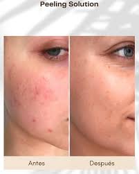 THE ORDINARY AHA 30% + BHA 2% Peeling Solution